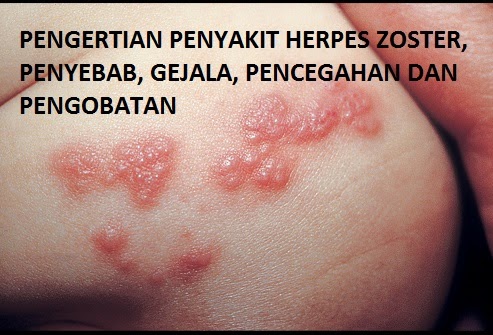 Pengertian Penyakit Herpes Zoster, Penyebab, Gejalan dan Pengobatan