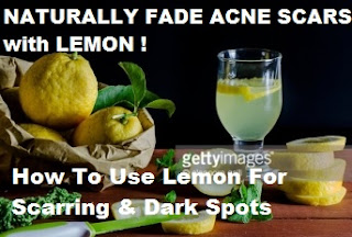 how to get rid of acne scars naturally