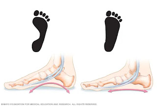 Postural Deformities - Scoliosis, Kyphosis, Lordosis, Knock knees, Flat foot