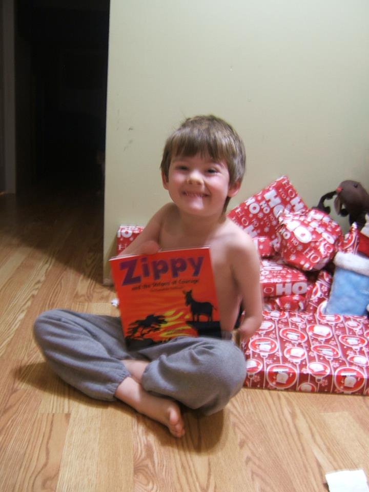 Underneath the Scars Living with Amniotic Band Syndrome The Next Chapter