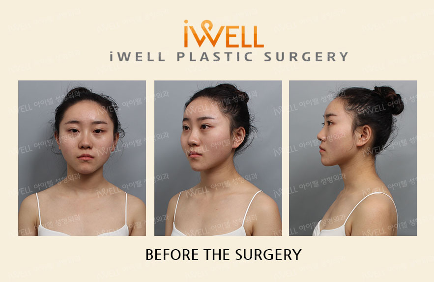 [Real Review] 3 combo Facial Contouring Surgery in Korea. iWELL