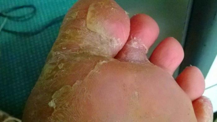 10 Cara Alami Dan Cepat Mengatasi Kutu Air Pada Kaki