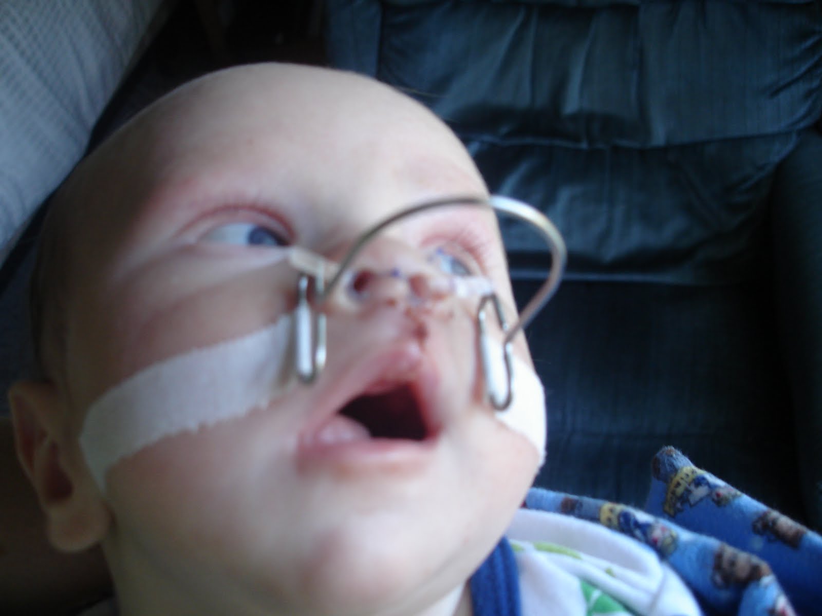 our-cleft-story-dallin-s-accessories