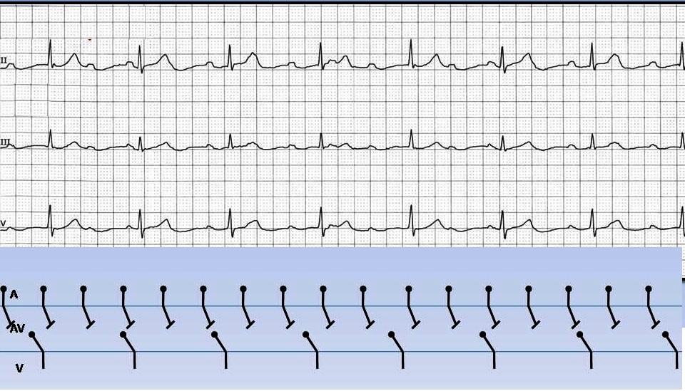 ECG Channel: Atrioventricular Block