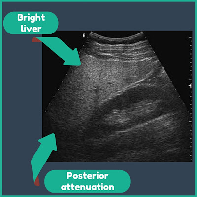 bright liver with posterior attenuation