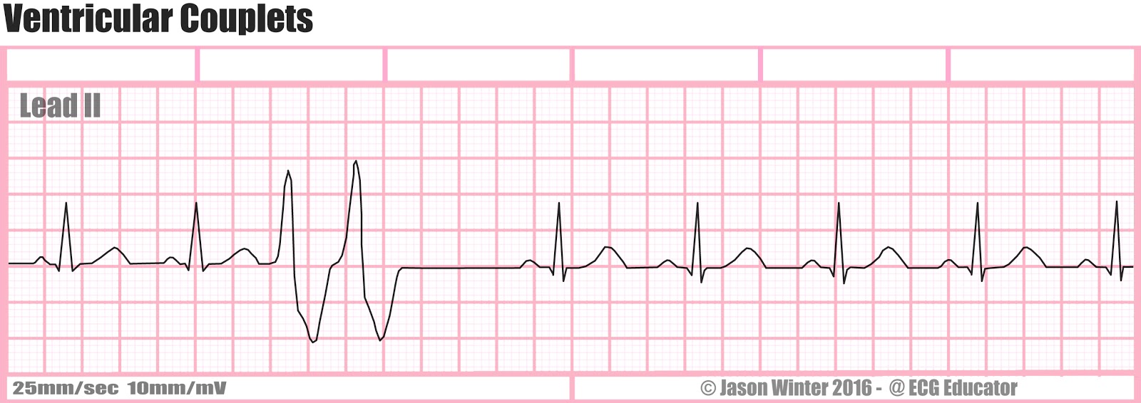 ECG Educator Blog Six Second ECG Rhythm Strips