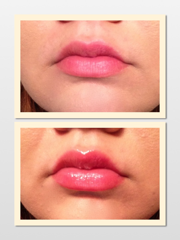 Two faced lip injection