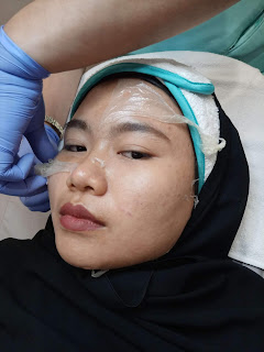merawat kulit wajah, treatment refresh diamond peel treatment, rekomendasi perawatan wajah minimal rasa sakit, Skin&Co Laser Clinic