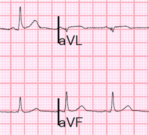 Dr. Smith's ECG Blog A Young Woman with Chest Pressure and Subtle