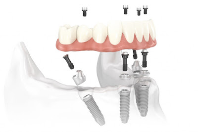 Thực hiện cấy ghép implant gắn răng liền 