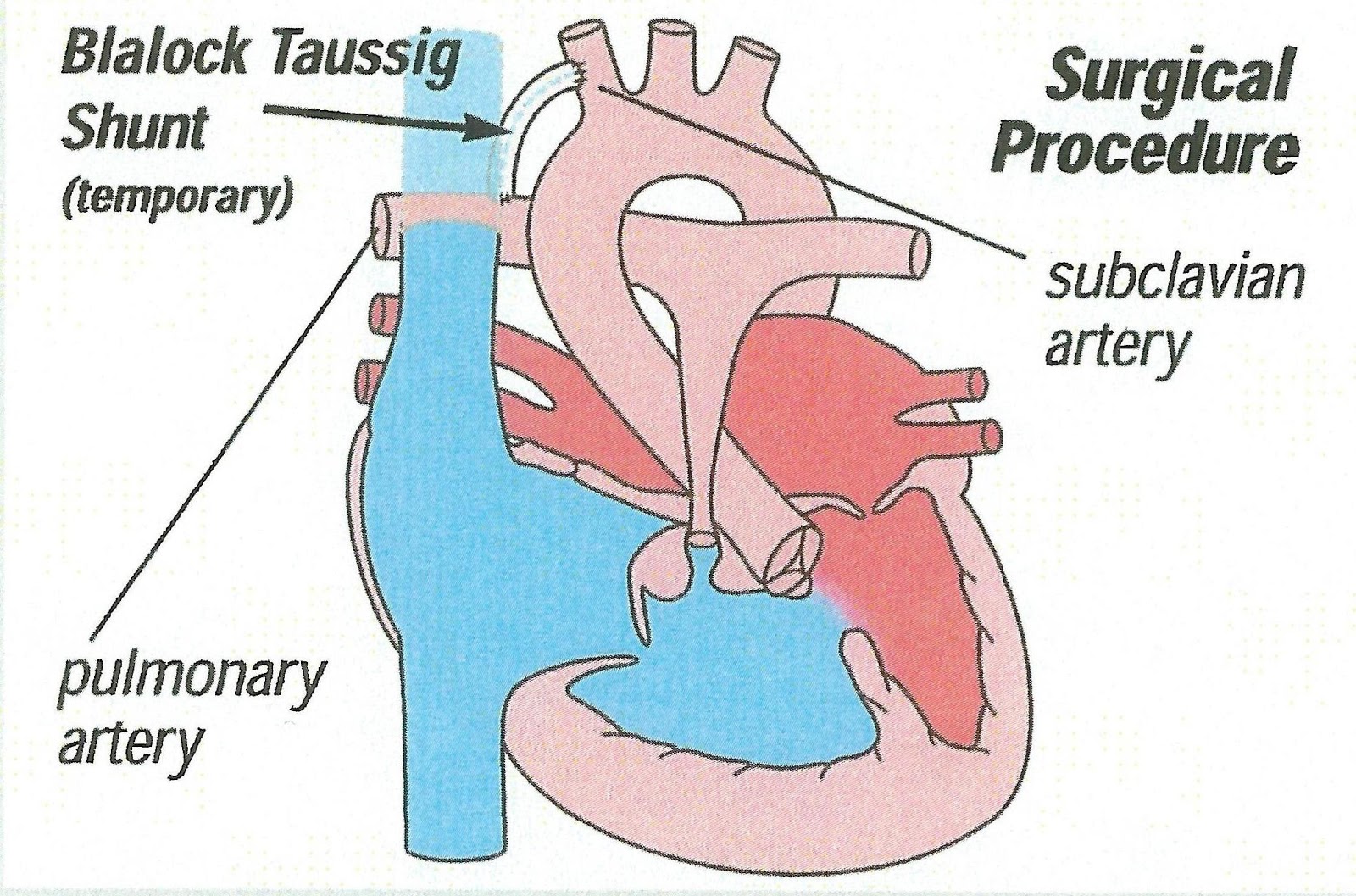 Matters of the Heart What is Tetralogy of Fallot?