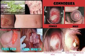 Obat Sipilis Dan Kencing Nanah Obat Sipilis Dan Kencing Nanah