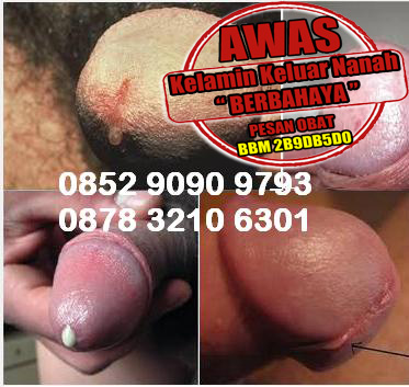 Infeksi Saluran Kencing Pengobatan Kencing Nanah Pada Pria Tradisional, Herbal & Alami Infeksi Saluran Kencing Pengobatan Kencing Nanah Pada Pria Tradisional, Herbal & Alami