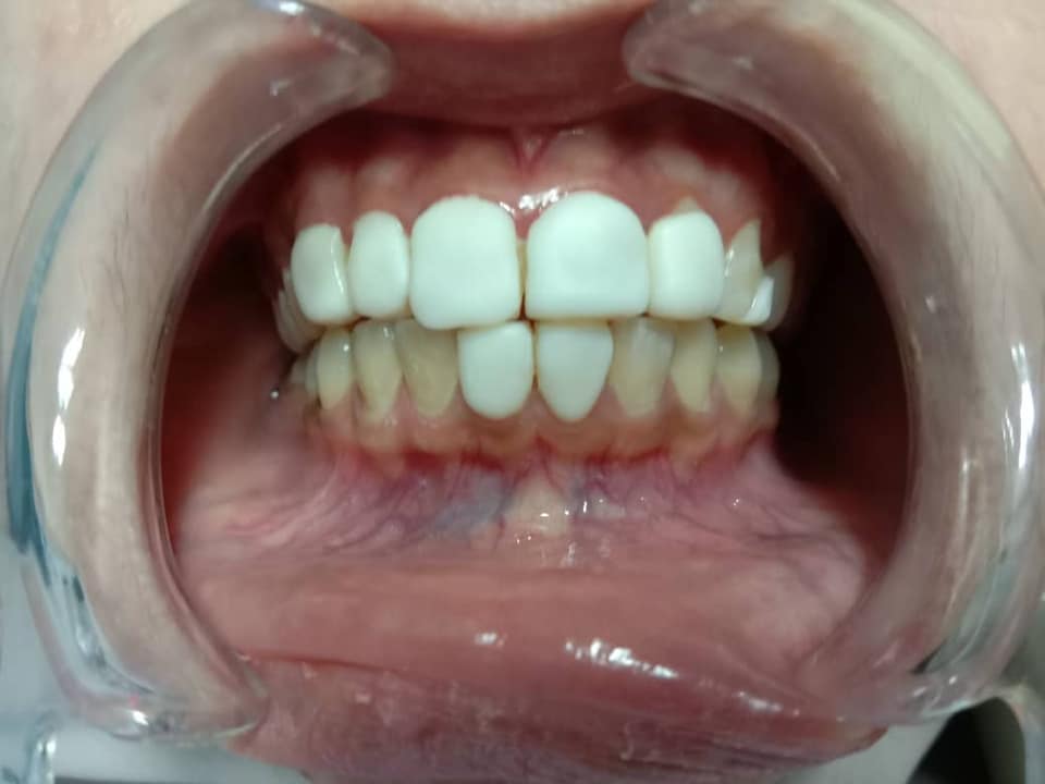 KLINIK PERGIGIAN SYARIFAH Fake veneer di beauty Spa