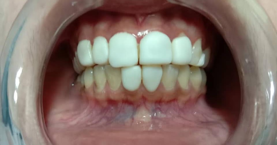 KLINIK PERGIGIAN SYARIFAH Fake veneer di beauty Spa