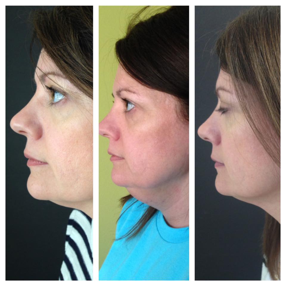 The Results Are In A Kybella Transformation 
