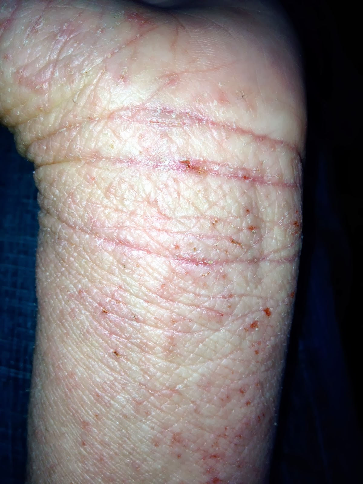 Scratching The Surface Of Topical Steroid Withdrawal Day 173 What The