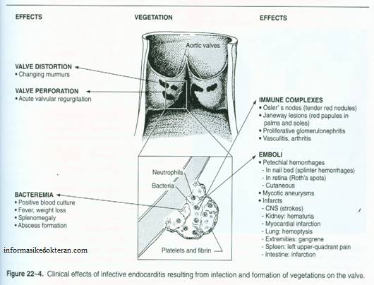 clinical effects infective endocarditis jantung