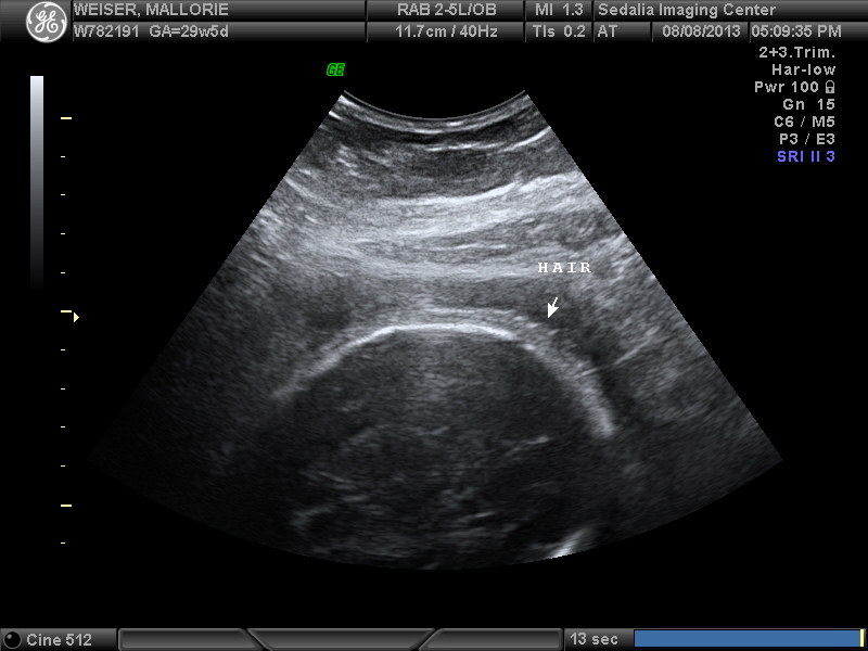3D Ultrasound: Can You See Hair On A 3d Ultrasound