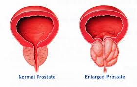 Cancer de prostata en pacientes jovenes. Ceea ce este convenabil pentru a face masaj de prostata