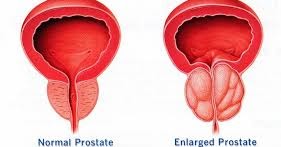 prostatitis a louise széna)