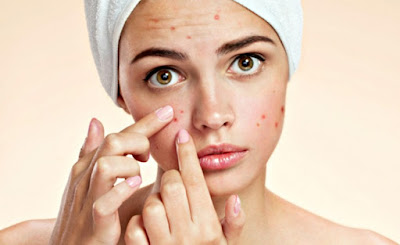 mitos e verdades sobre acne