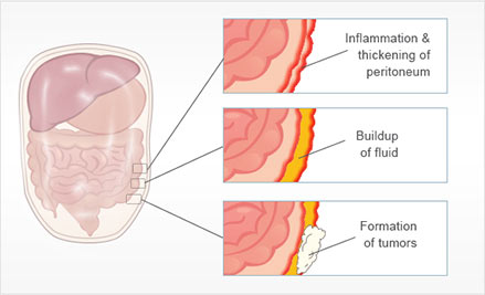 Peritoneal Mesothelioma Peritoneal Mesothelioma