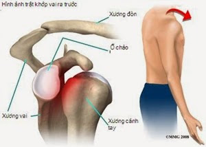 biểu hiện bệnh thoái hóa khớp vai