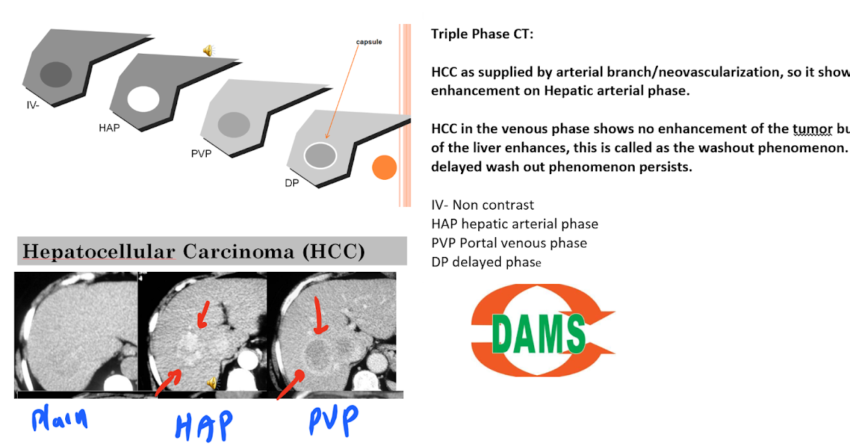 HCC on CT Teaching Flashcard Sumer #39 s Radiology Blog HCC on CT Teaching Flashcard Sumer #39 s Radiology Blog