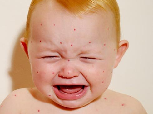 ¿Cómo cuidar a tu hijo cuando tiene varicela? 7
