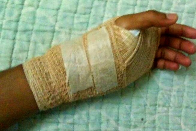 Produk Mutiara Bumi: Testimoni Rawat Tapak Tangan Lecur Kena Air Panas