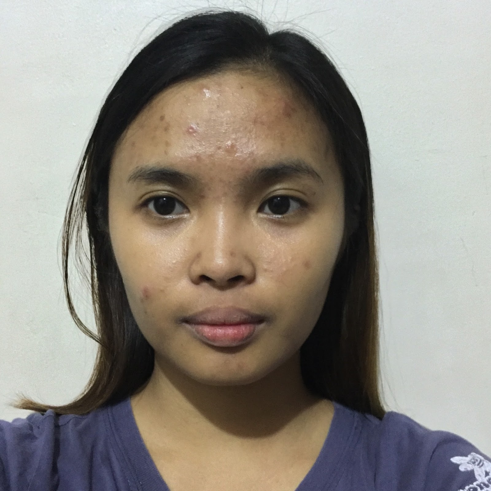 Buy Accutane Online Mastercard