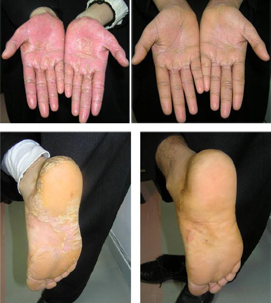 Apitherapy News Propolis Helps Treat Palmoplantar Psoriasis