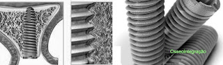 implantes