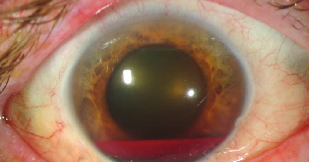Study Medical Photos Hyphema a pooling or collection of blood inside
