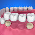 Cầu răng sứ phục hình răng bị mất hiệu quả
