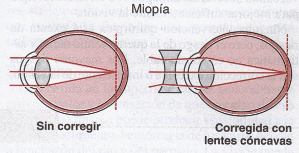 lentes concavos miopia