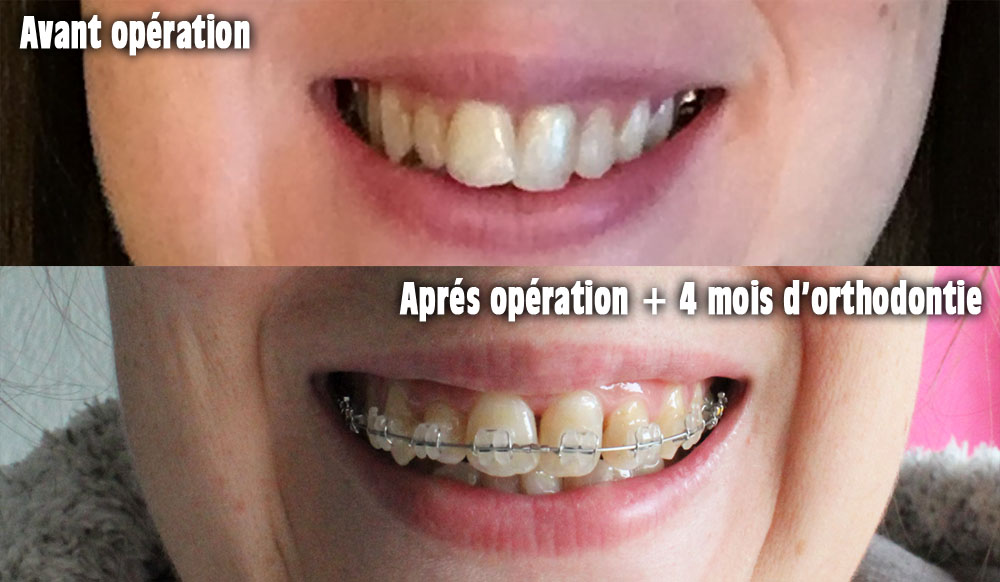 Orthodontie adulte bouche en chantier juillet 2016