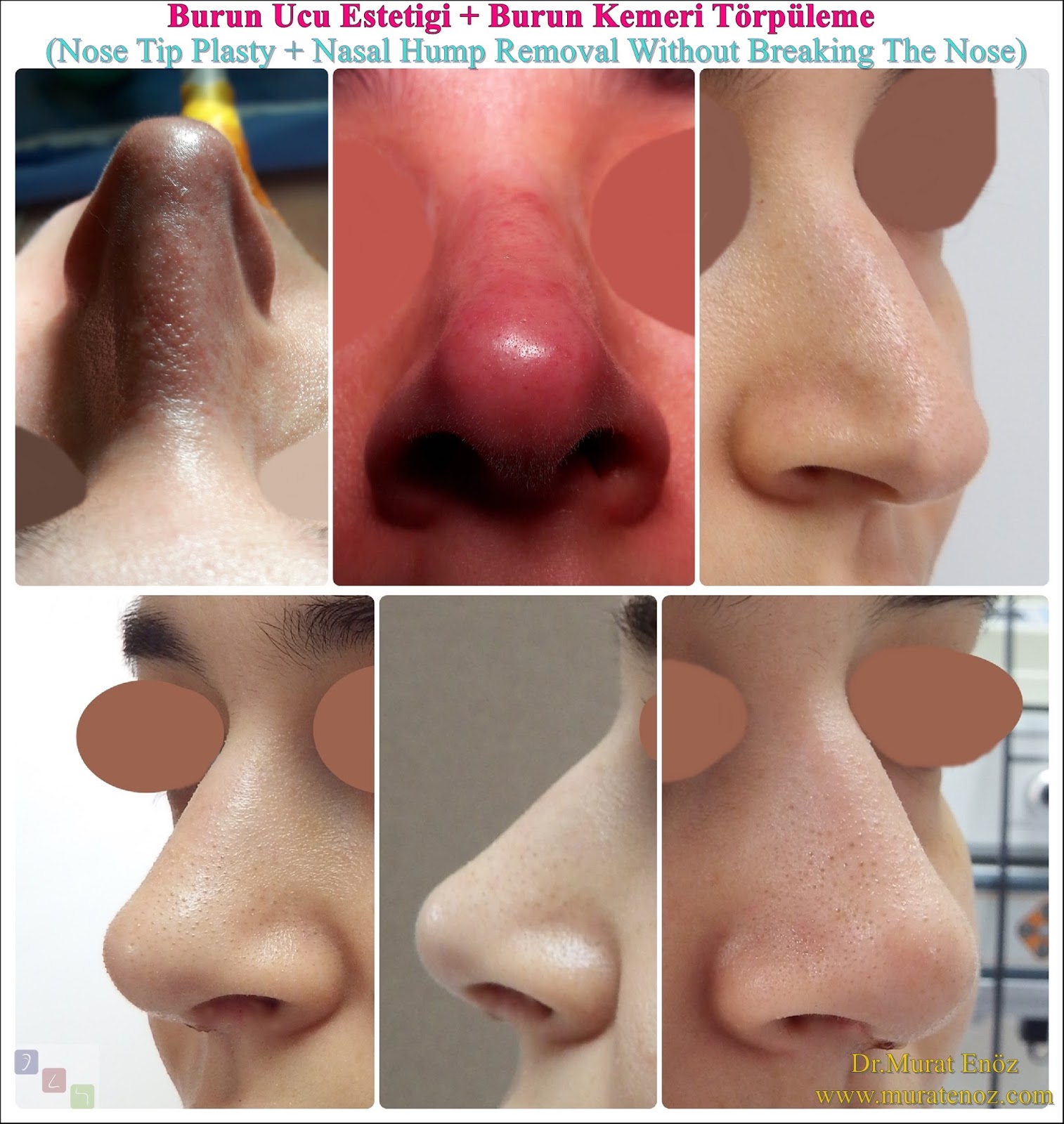 Nasal Valve Collapse And Treatment