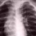 An Unexpected New Lung Function Has Been Found - They Make Blood