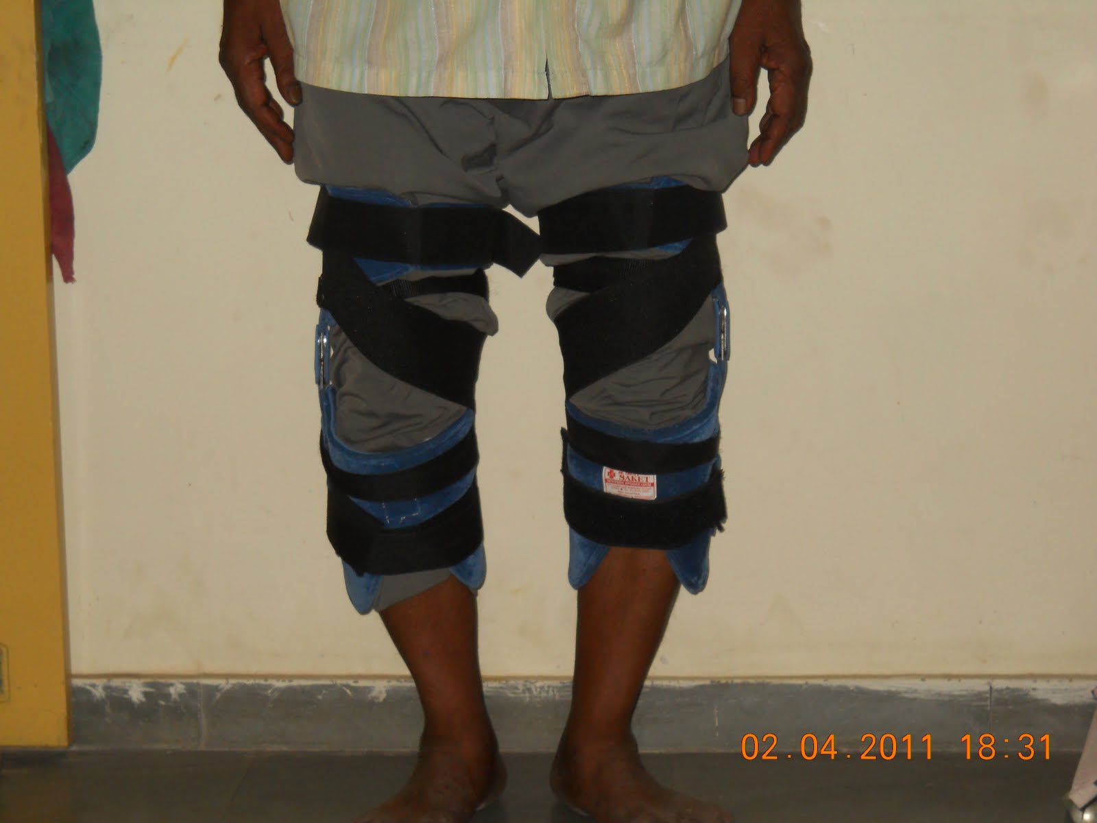 polycentric hinge knee brace for bow legs