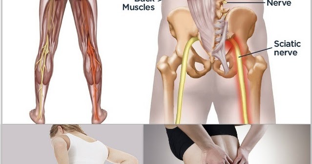 Natural Remedies For Slipped Disc Pain Natural Remedies For Slipped Disc Pain