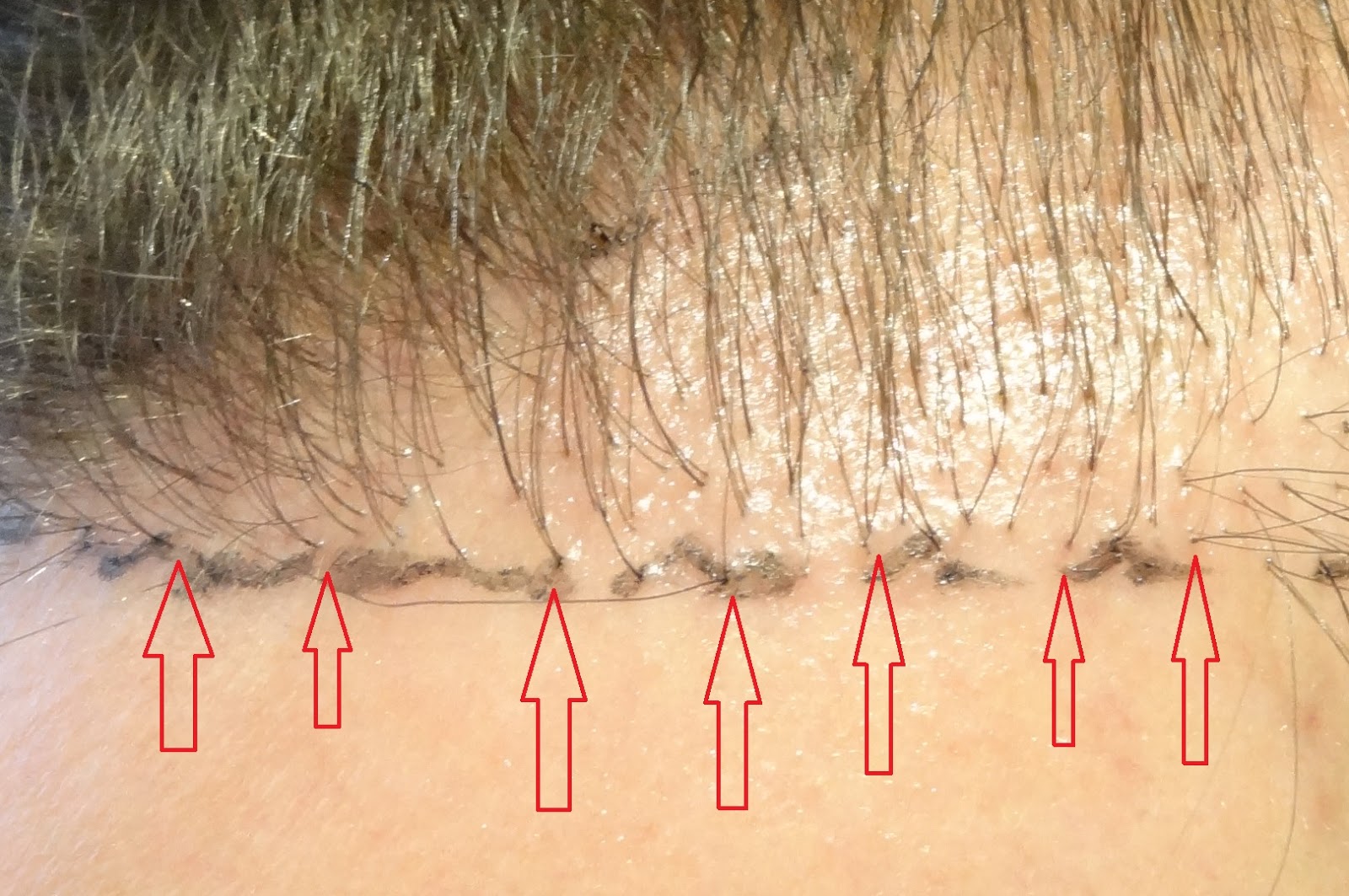 Repairing a failed hair transplant Repairing a failed hair transplant