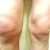 Knee Effusion - Water On Knee