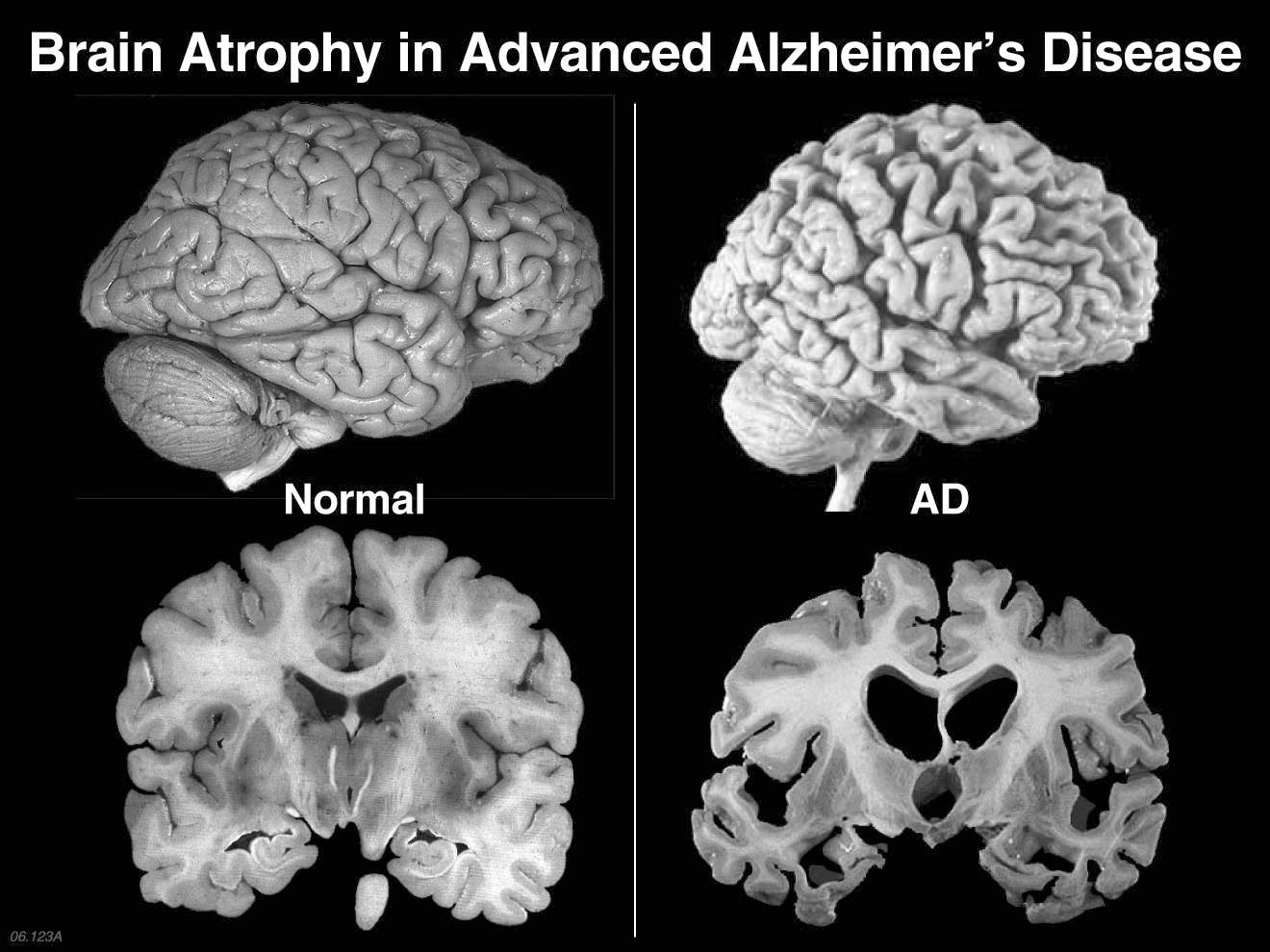 Normal Brain vs. Brain With Dementia US News