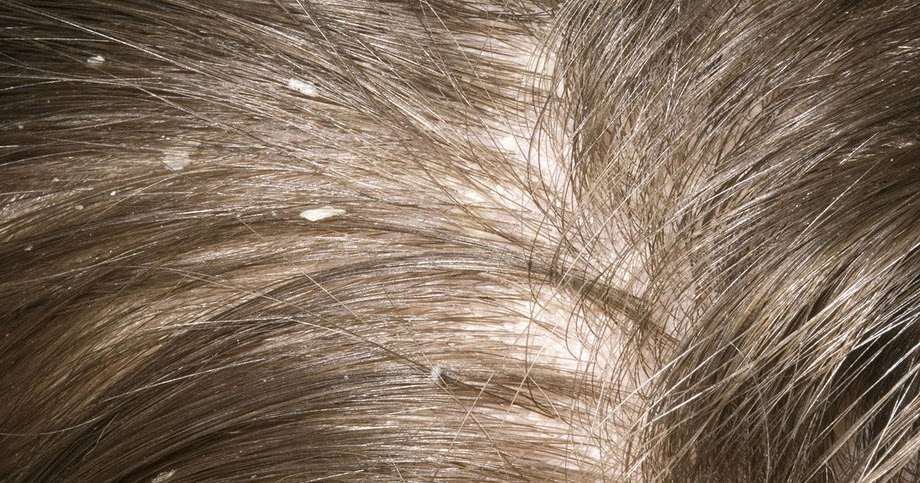 Себорея волосяного покрова. Как избавиться от перхоти на голове подростку. Как избавиться от перхоти на голове подростку. Перхоть на темных волосах. Как избавиться от перхоти на голове подростку.