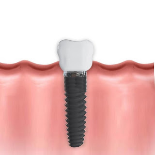 Zubni implant Nešković Dent, Novi Sad