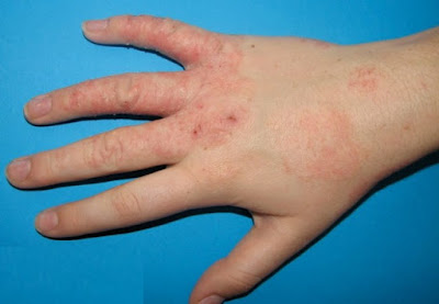 Eczema thể địa