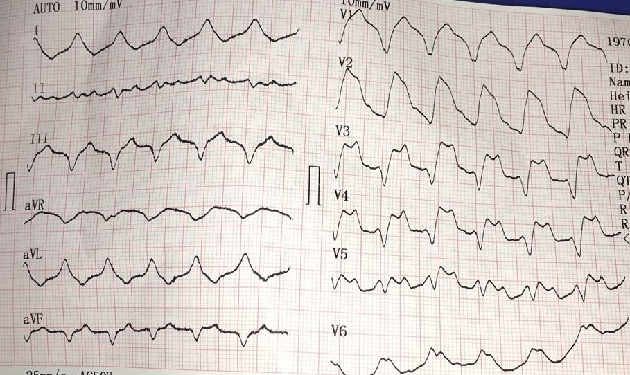 Cardiology window ECG changes in hyperkalemia