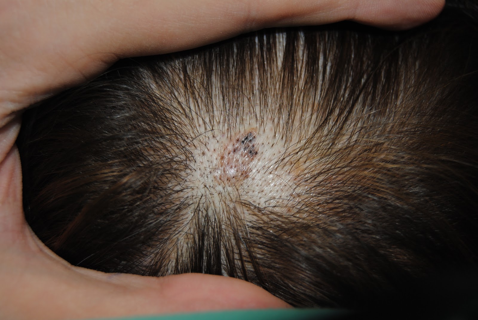 DermatologoValencia Una mancha en la cabeza ¿Peca buena o melanoma? Da tu opinión con un
